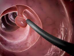 Endoscopy image