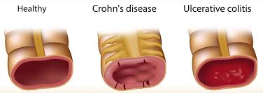 IBD image