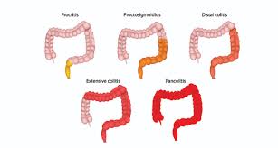 IBD image
