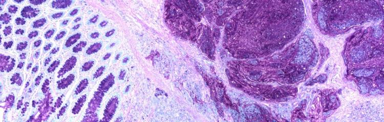 A colon cancer tissue scan; Fred Hutch.